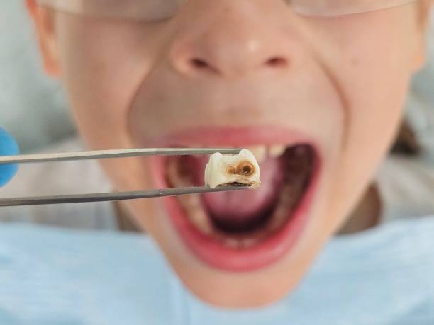 Best Knocked-Out Tooth (Avulsed Tooth) Treatment in Anamosa, IA